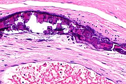 Medial calcific sclerosis - Libre Pathology
