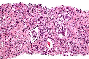 prostatic adenocarcinoma pathology outlines)