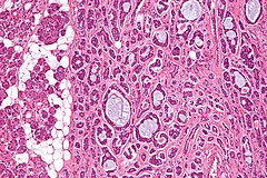 cystic carcinoma adenoid intermed adcc nephron
