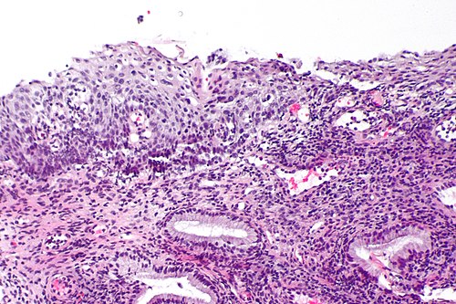 High grade squamous intraepithelial lesion - 2 -- intermed mag.jpg