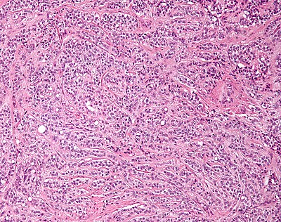 Sertoli cell tumour low mag.jpg