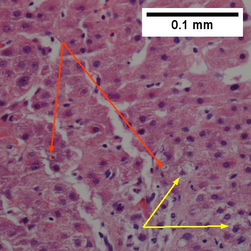 Bile plugs in cannaliculi (red arrows), feathery degeneration producing foamy macrophage like hepatocytes (yellow arrows)(400X).