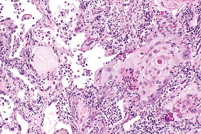 Lung squamous carcinoma -- intermed mag.jpg