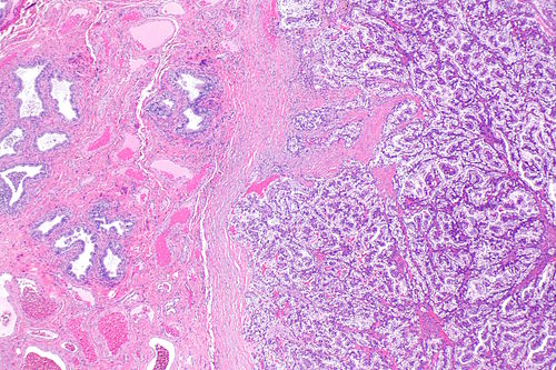 Papillary cystadenoma of epididymis -- very low mag.jpg