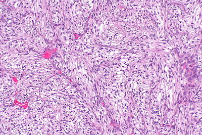 Sarcomatoid differentiation in renal cell carcinoma -- intermed mag.jpg