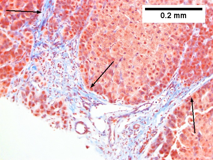 Primary sclerosing cholangitis in patient with history of ulcerative colitis.