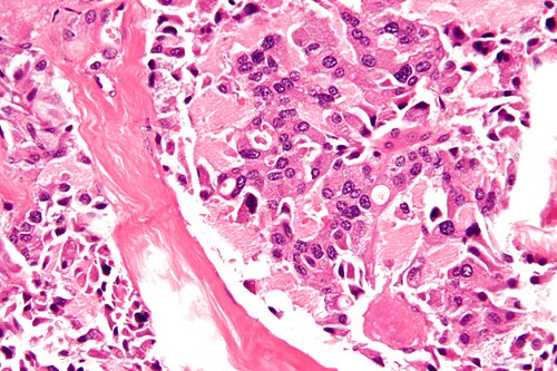 Medullary thyroid carcinoma - 2 - very high mag.jpg