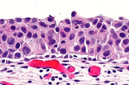 Urothelial carcinoma in situ -- very high mag.jpg