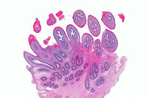 Laryngeal squamous papillomas
