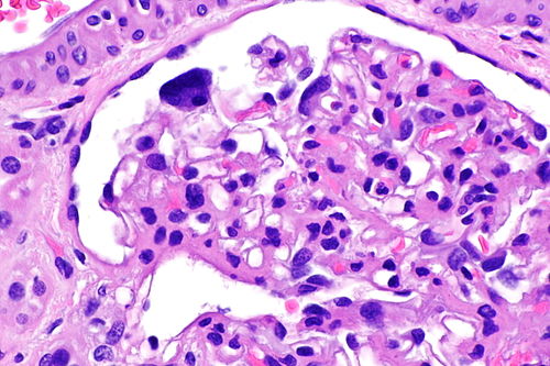 Cystinosis - kidney -- very high mag.jpg