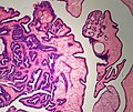 Squamous papilloma libre pathology
