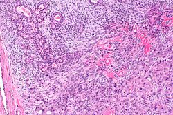 Carcinoma ex pleomorphic adenoma - a1 -- intermed mag.jpg