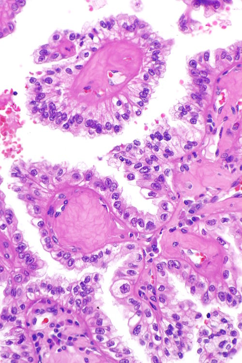 Hereditary leiomyomatosis and renal cell carcinoma associated RCC -- high mag.jpg
