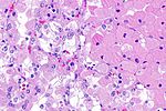 Eosinophilic, solid and cystic renal cell carcinoma - 3 -- high mag.jpg