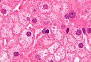 Ground glass hepatocyte - Libre Pathology
