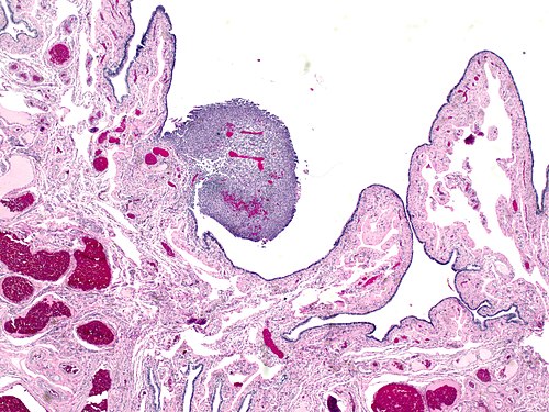 Nodular histiocytic hyperplasia in fallopian tube 1.jpg