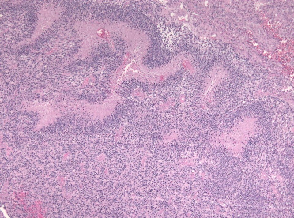 File:GBM pseudopalisading necrosis.jpg