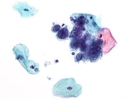 Herpes simplex virus pap test.jpg