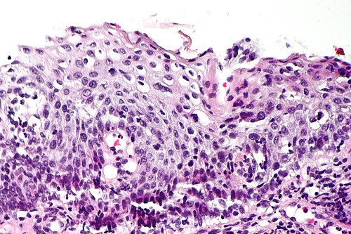 High grade squamous intraepithelial lesion - 2 -- high mag.jpg