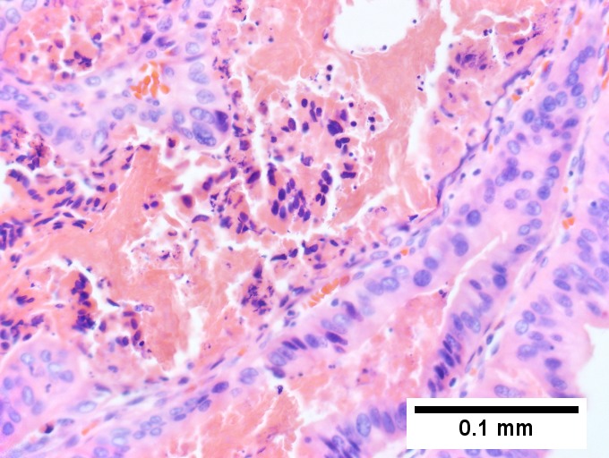 Intraductal papillary neoplasm of common bile duct with associated invasive carcinoma.