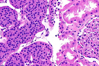 Renal oncocytoma -- high mag.jpg