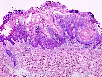 Pathology Outlines Seborrheic Keratosis Pathology Outlines Lipoid