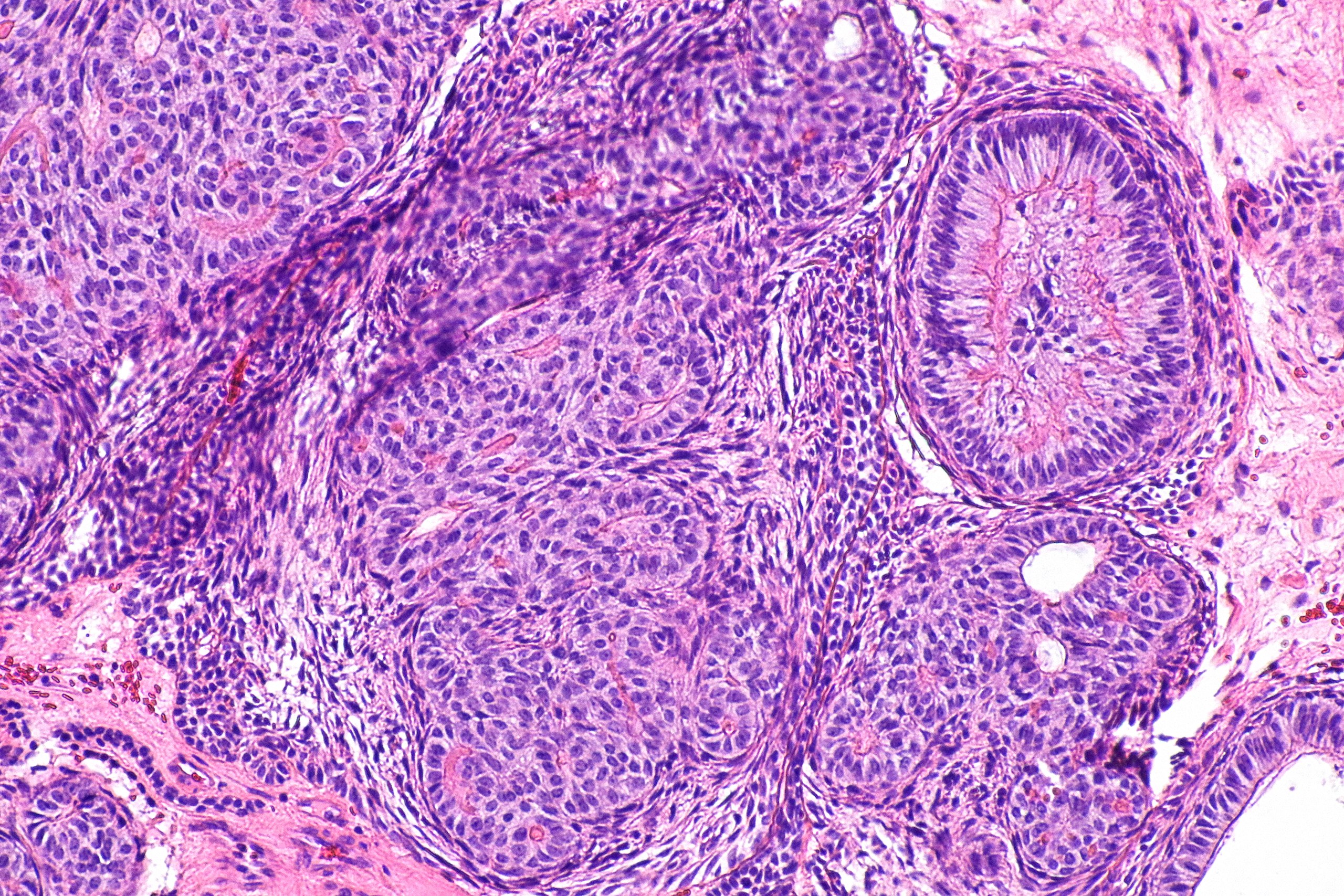 Adenomatoid tumor pathology outlines