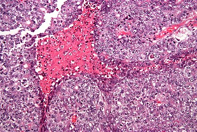 Embryonal carcinoma - high mag.jpg