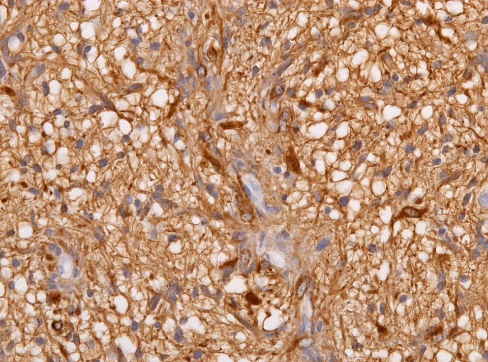File:Neuropathology case V 04.jpg