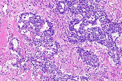 Yolk sac tumour with hyaline bodies -- intermed mag.jpg