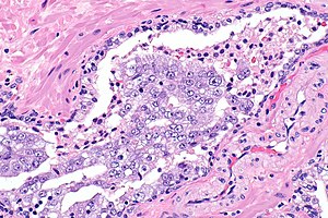 histopathology of prostate adenocarcinoma Sulfa- N prosztatitis
