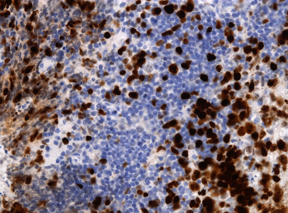 File:Neuropathology case VIII 04.jpg