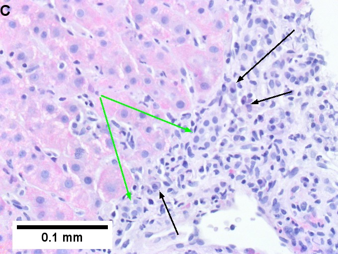 Drug induced liver injury in a young adult man