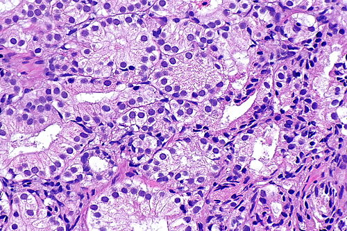 Adenosis of prostate -- high mag.jpg