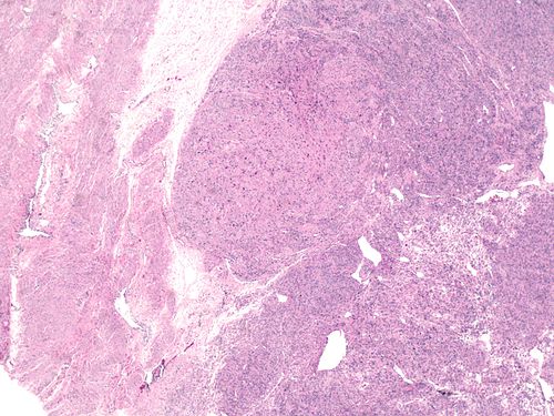 Atypical leiomyoma with bizarre nuclei low magnification.jpg