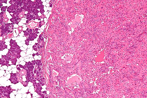 Parotid gland oncocytoma - intermed mag.jpg