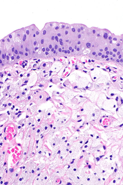 Urinary bladder xanthoma -- high mag.jpg