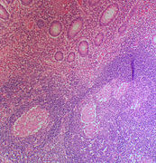 Silicone granuloma - Libre Pathology