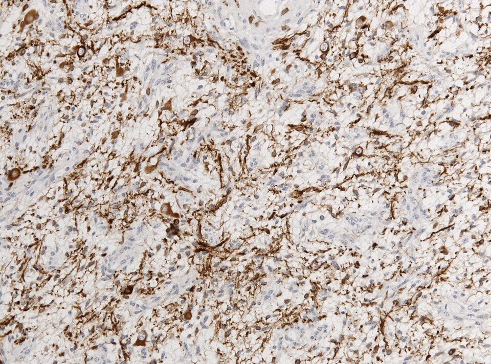 File:Neuropathology case V 06.jpg