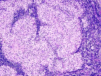 Sarcoidosis - Libre Pathology