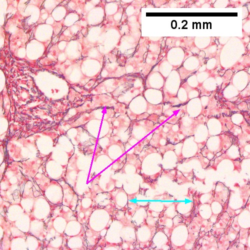Reticulin shows thick black lines (red arrows) of collapse, without portal central bridging. The apparent loss of reticulin due to steatosis (double head cyan arrow) should not be considered regeneration or hepatoma (Row 3 Left 200X).
