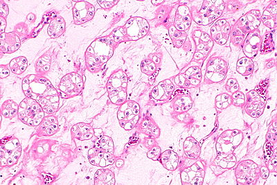 Renal hybrid tumour - nests - 2 -- intermed mag.jpg