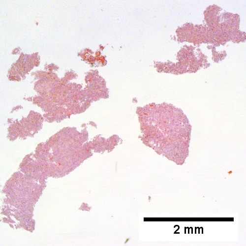 Fragments of tumor at low power mimic normal hepatocyte groups without triads (Row 1 Left 20X).