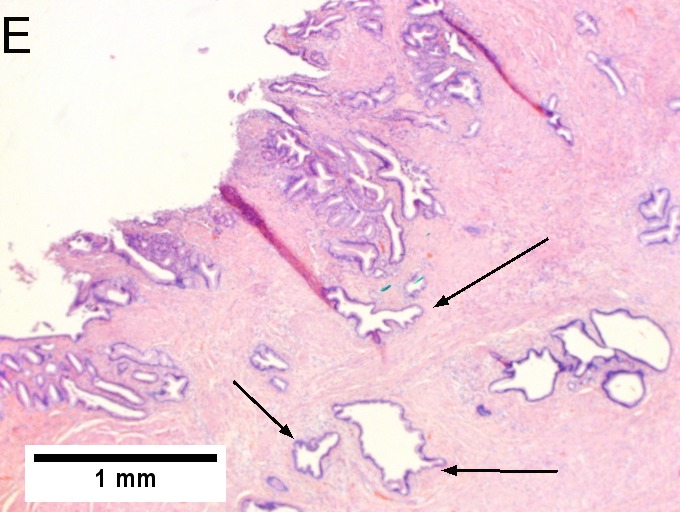 Invasive carcinoma of duodenal ampulla.
