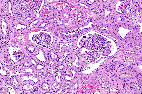 Cystinosis - kidney -- intermed mag.jpg