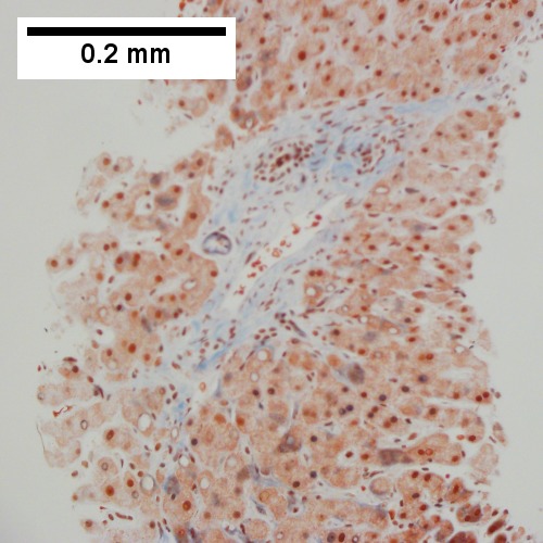 Trichrome shows periportal fibrosis; no bridging was seen (200X).