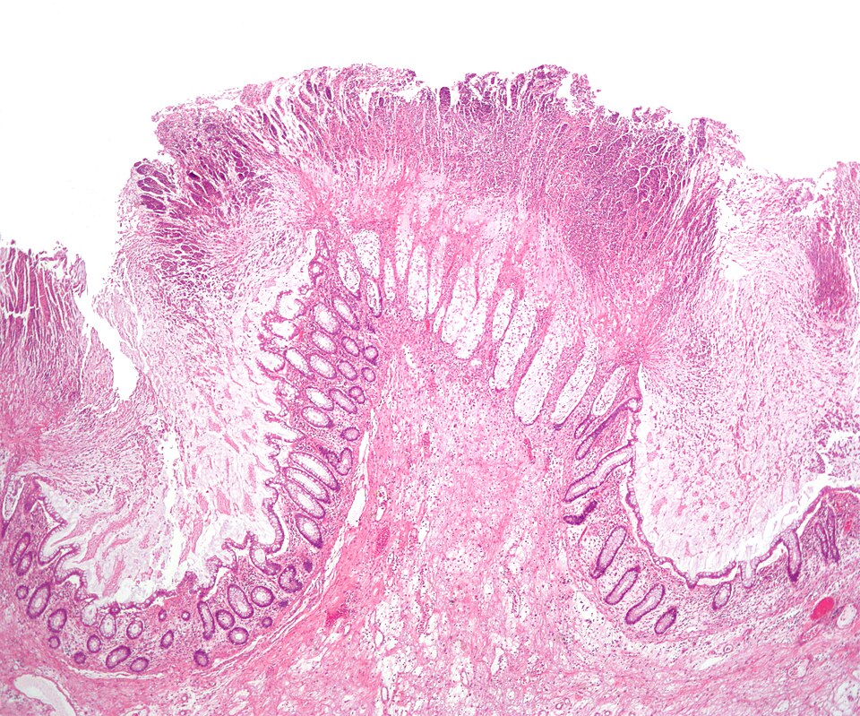 File:Colonic pseudomembranes low mag.jpg