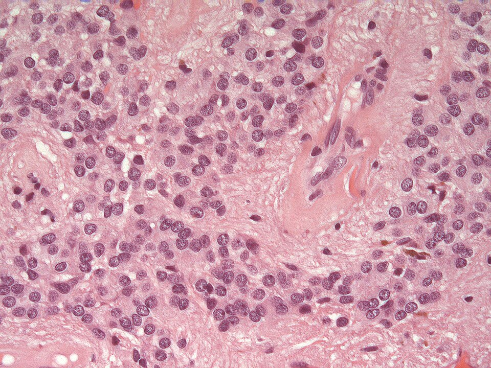 File:Ependymoma H&E.jpg