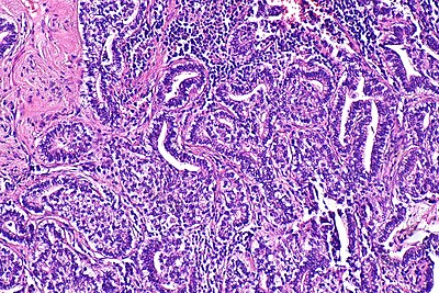 Fetal adenocarcinoma of the lung -- intermed mag.jpg