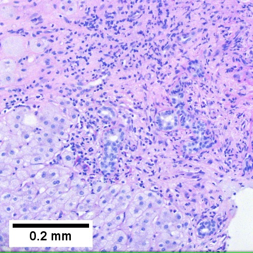 PAS-D shows tortuous bile ductules at edge of scar with minimal inflammation (200X)